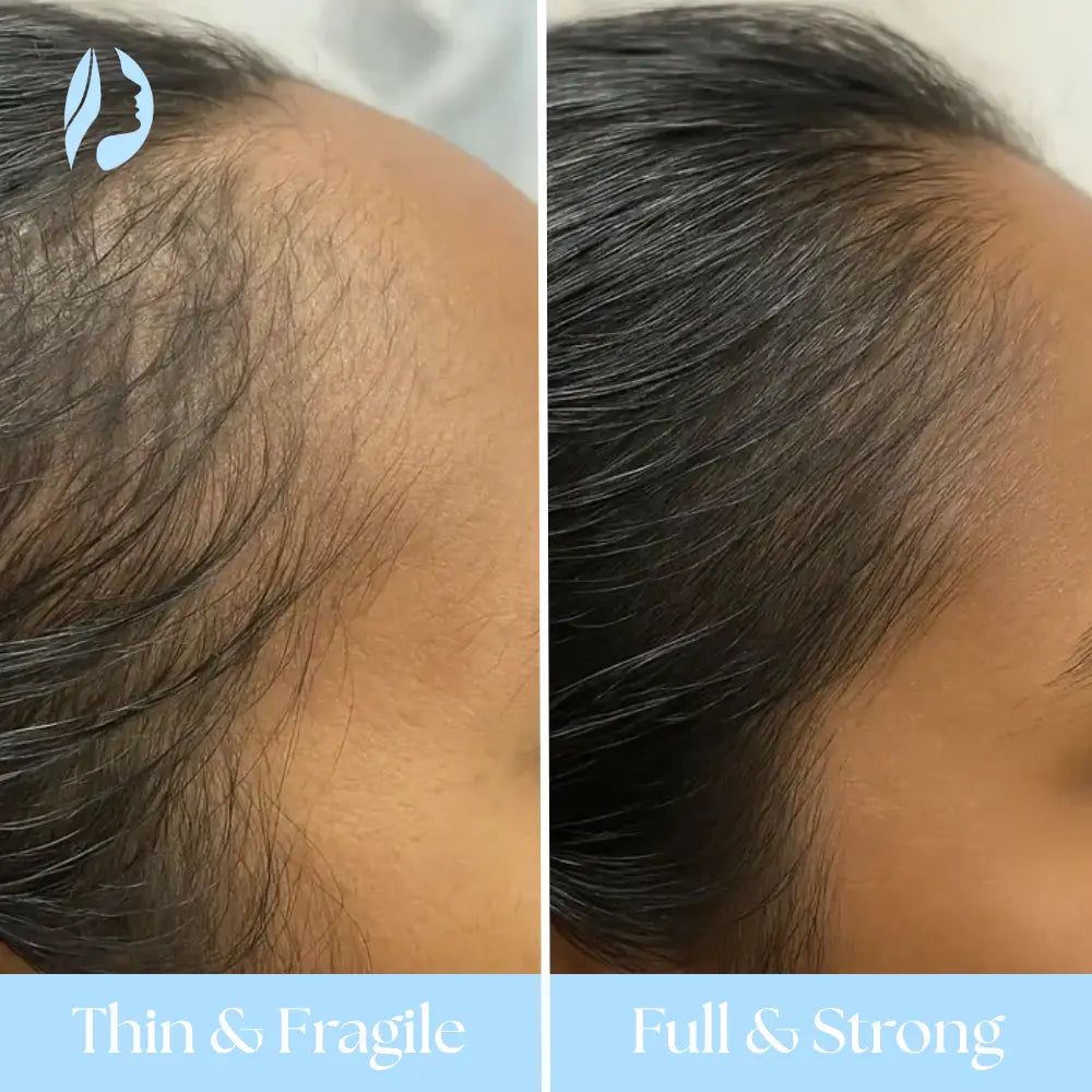 AuraBrush 4-in-1 + Rosemary Scalp Oil – Complete Therapy